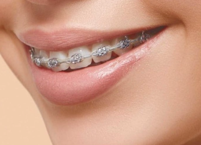 Braces Plan - Smile Map